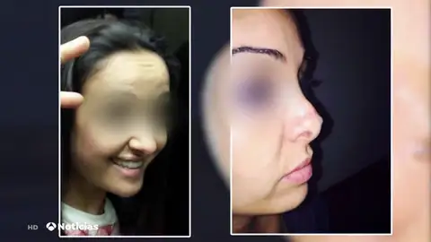 NUEVA RINOPLASTIA NUEVA RINOPLASTIA