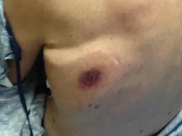 Un hombre muere 48 horas después de infectarse con una bacteria 'comecarne' en la playa Un hombre muere 48 horas después de infectarse con una bacteria 'comecarne' en la playa