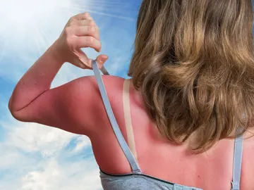 Quemadura solar Quemadura solar