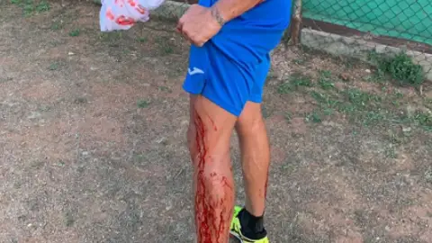 La pierna de Puyol ensangrentada La pierna de Puyol ensangrentada