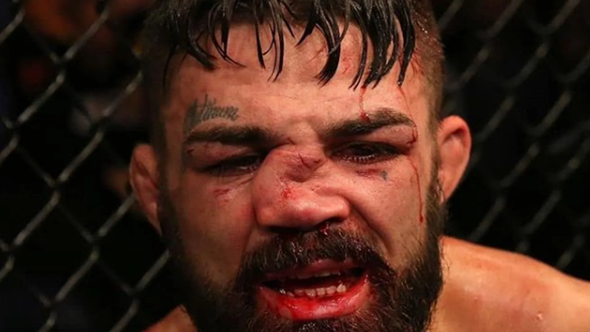 Así quedó la nariz de Mike Perry Así quedó la nariz de Mike Perry