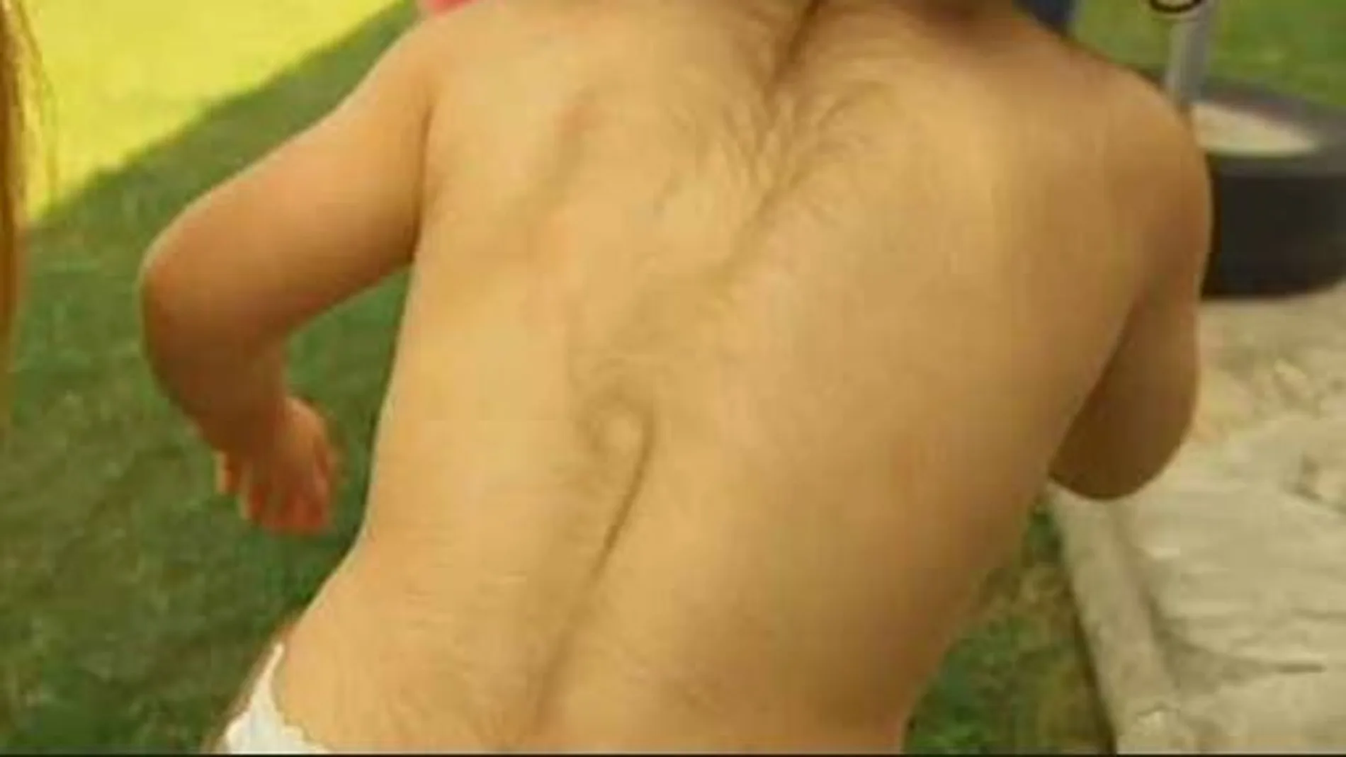 Uno de los bebés afectados por omeprazol defectuoso Uno de los bebés afectados por omeprazol defectuoso