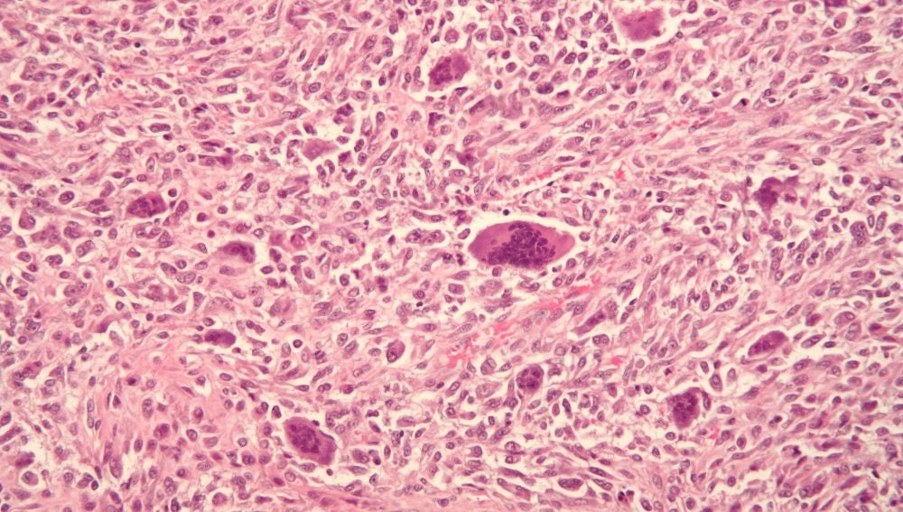 Osteosarcoma 
