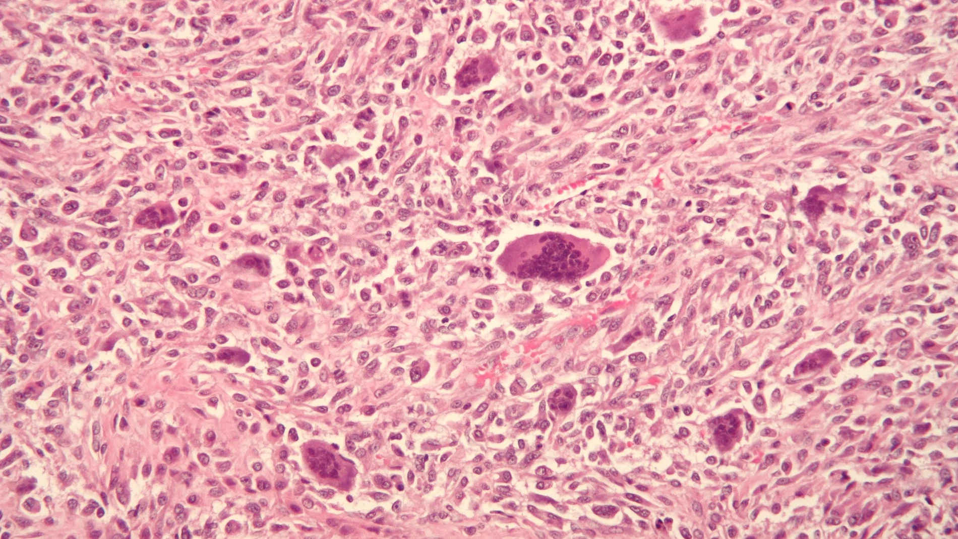 Osteosarcoma Osteosarcoma