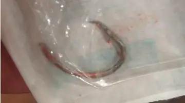 El anzuelo que los servicios médicos tuvieron que quitar del cuello de Juan El anzuelo que los servicios médicos tuvieron que quitar del cuello de Juan