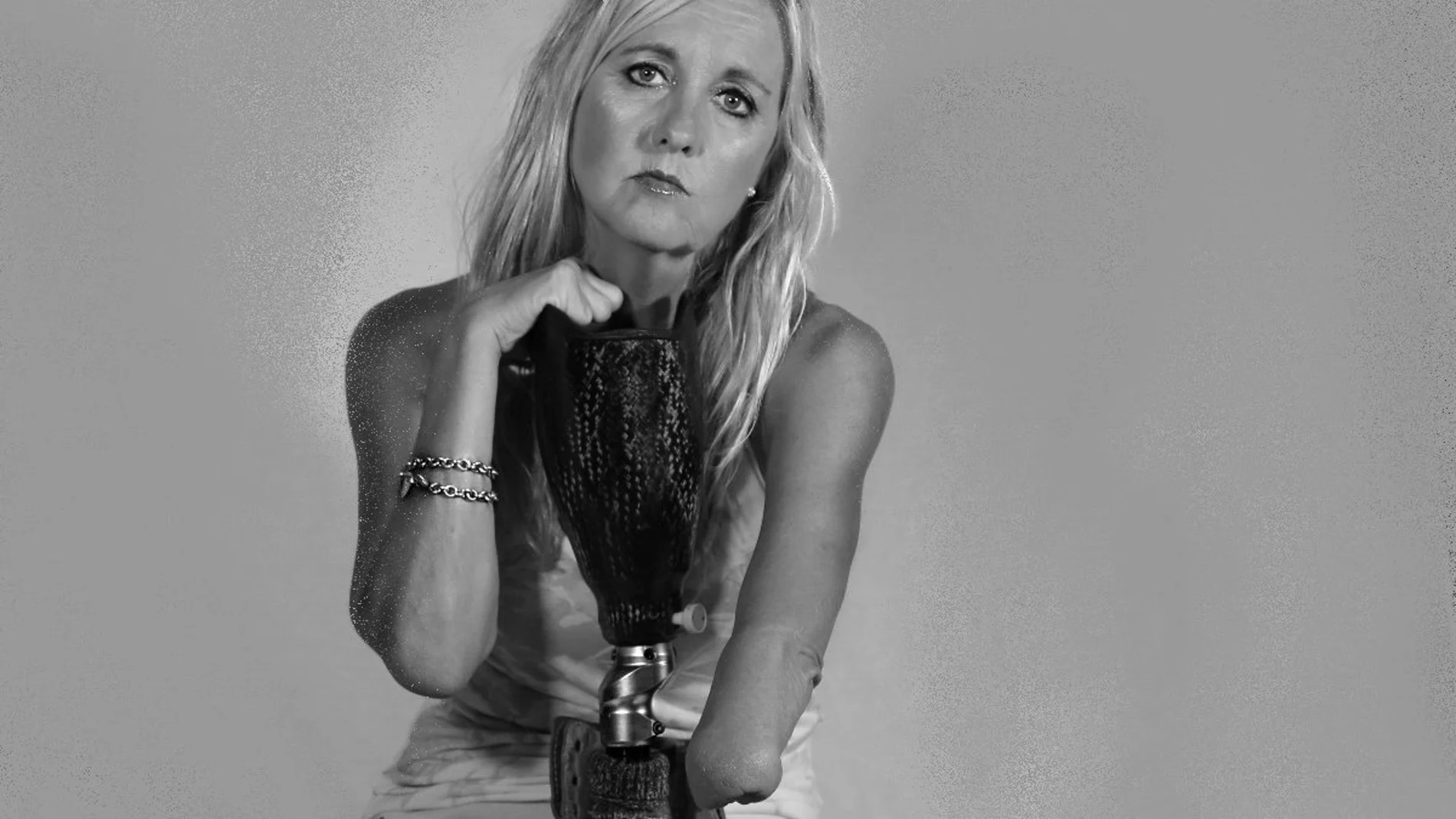 Le amputaron las dos piernas, el brazo izquierdo y varios dedos de su mano derecha Le amputaron las dos piernas, el brazo izquierdo y varios dedos de su mano derecha