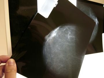 Fotografía de archivo de una prueba radiológica de mama