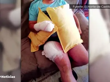 Un hombre sufre quemaduras en la mano y el muslo al explotarle el móvil en el bolsillo en Valladolid Un hombre sufre quemaduras en la mano y el muslo al explotarle el móvil en el bolsillo en Valladolid