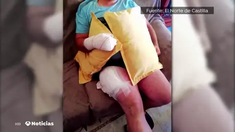 Un hombre sufre quemaduras en la mano y el muslo al explotarle el móvil en el bolsillo en Valladolid Un hombre sufre quemaduras en la mano y el muslo al explotarle el móvil en el bolsillo en Valladolid