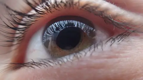 Ojo con glaucoma Ojo con glaucoma