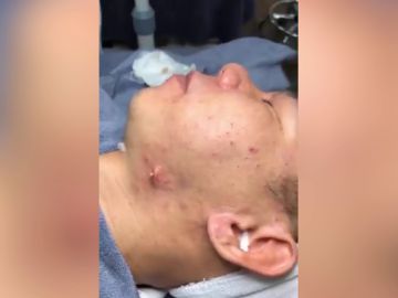 Doctor explota un grano Doctor explota un grano