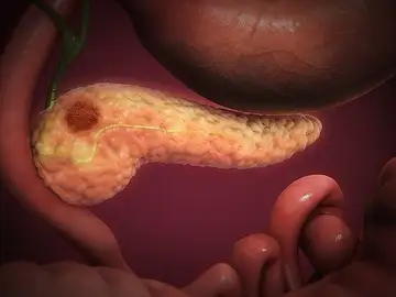 Cáncer de páncreas Cáncer de páncreas