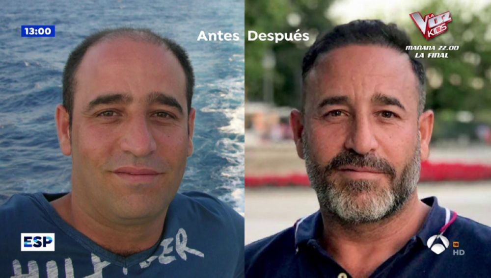 Trasplante capilar nacional VS operación en Turquía: pros y contras