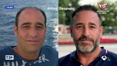 Trasplante capilar nacional VS operación en Turquía: pros y contras