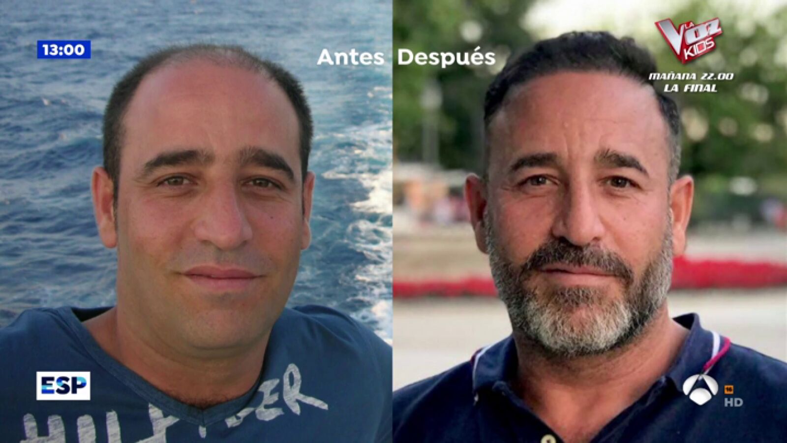 Trasplante capilar nacional VS operación en Turquía: pros y contras
