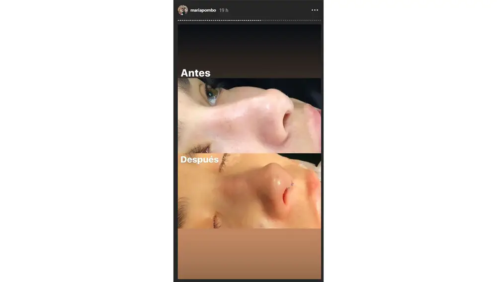 María Pombo muestra el antes y el después de su operación de nariz 