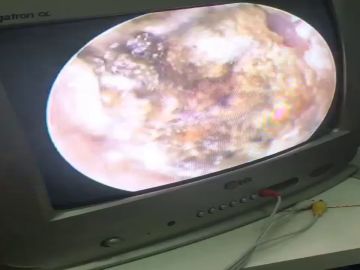 Un doctor limpia las orejas de una paciente Un doctor limpia las orejas de una paciente