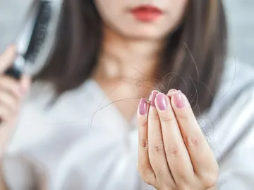 Pérdida de cabello Pérdida de cabello