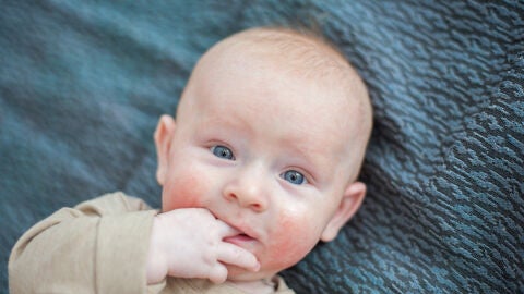 Bebé con dermatitis