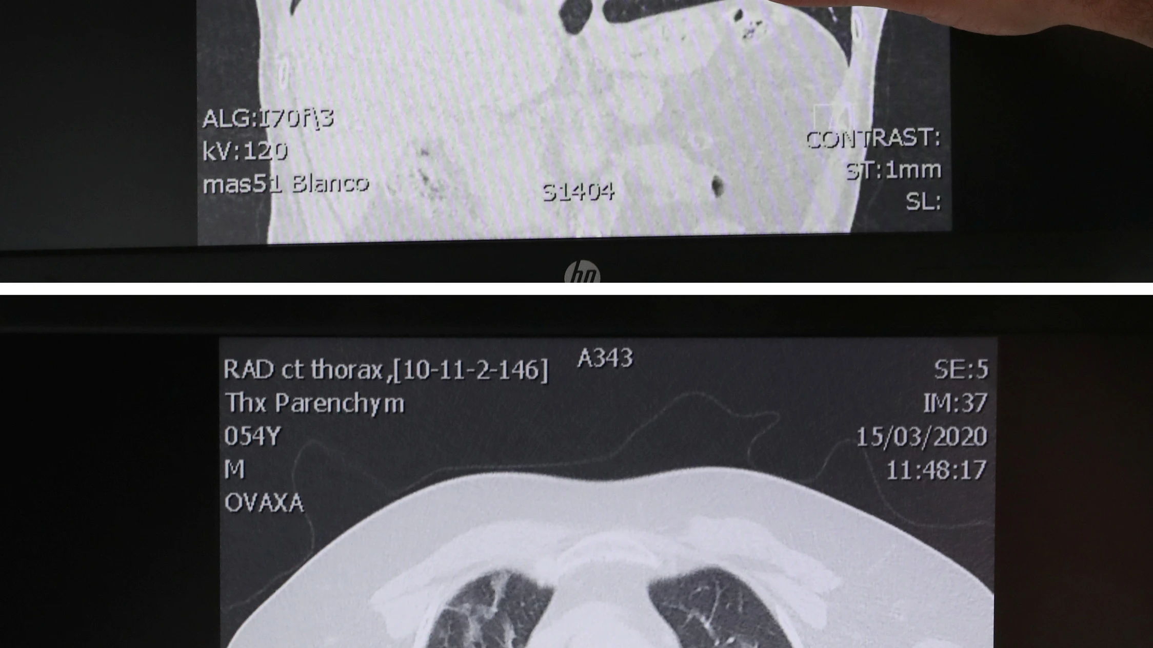 Pulmones afectados COVID-19