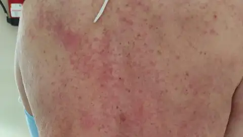 Efectos en la piel del coronavirus Efectos en la piel del coronavirus