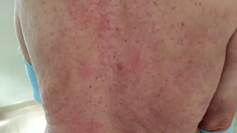 Efectos en la piel del coronavirus Efectos en la piel del coronavirus