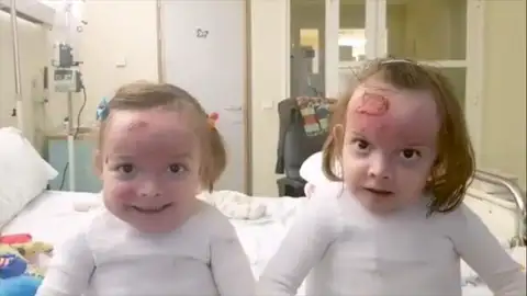 Carla y Noa Dos gemelas con 'piel de mariposa'