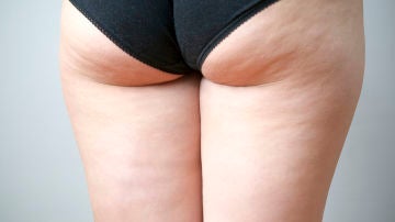 Celulitis Celulitis