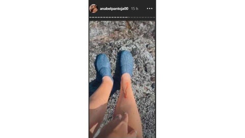 Las heridas de Anabel Pantoja tras su aparatoso accidente 