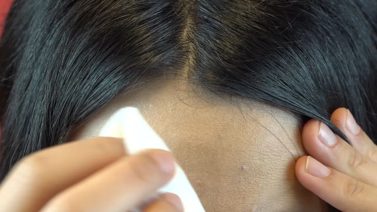 Por Que Salen Granitos En La Frente Como Puedes Evitarlo Video Por Que Salen Granitos En La Frente Como Puedes Evitarlo Video