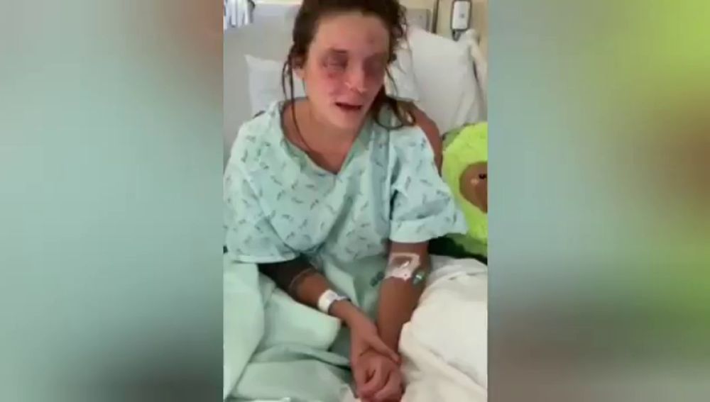 Una joven española pide ayuda desde EEUU tras quedarse ciega por un accidente con sosa caústica 