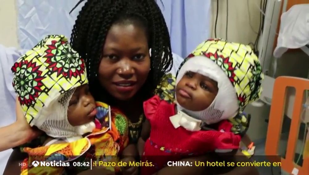 Separan con éxito a dos niñas siamesas unidas por la cabeza en un hospital del Vaticano Bambino Gesù