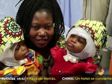 Separan con éxito a dos niñas siamesas unidas por la cabeza en un hospital del Vaticano Bambino Gesù