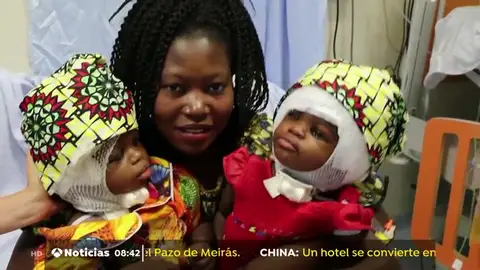 Separan con éxito a dos niñas siamesas unidas por la cabeza en un hospital del Vaticano Bambino Gesù Separan con éxito a dos niñas siamesas unidas por la cabeza en un hospital del Vaticano Bambino Gesù