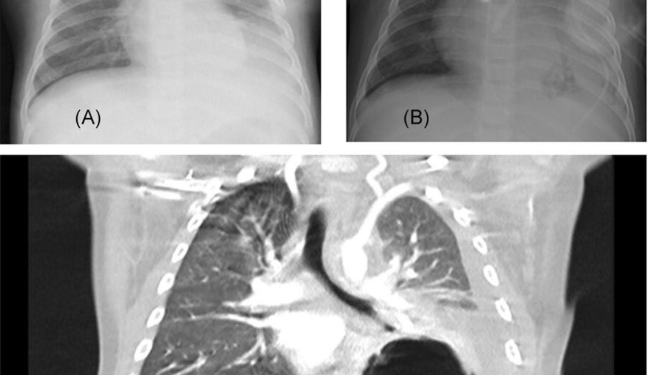 Pulmones con coronavirus