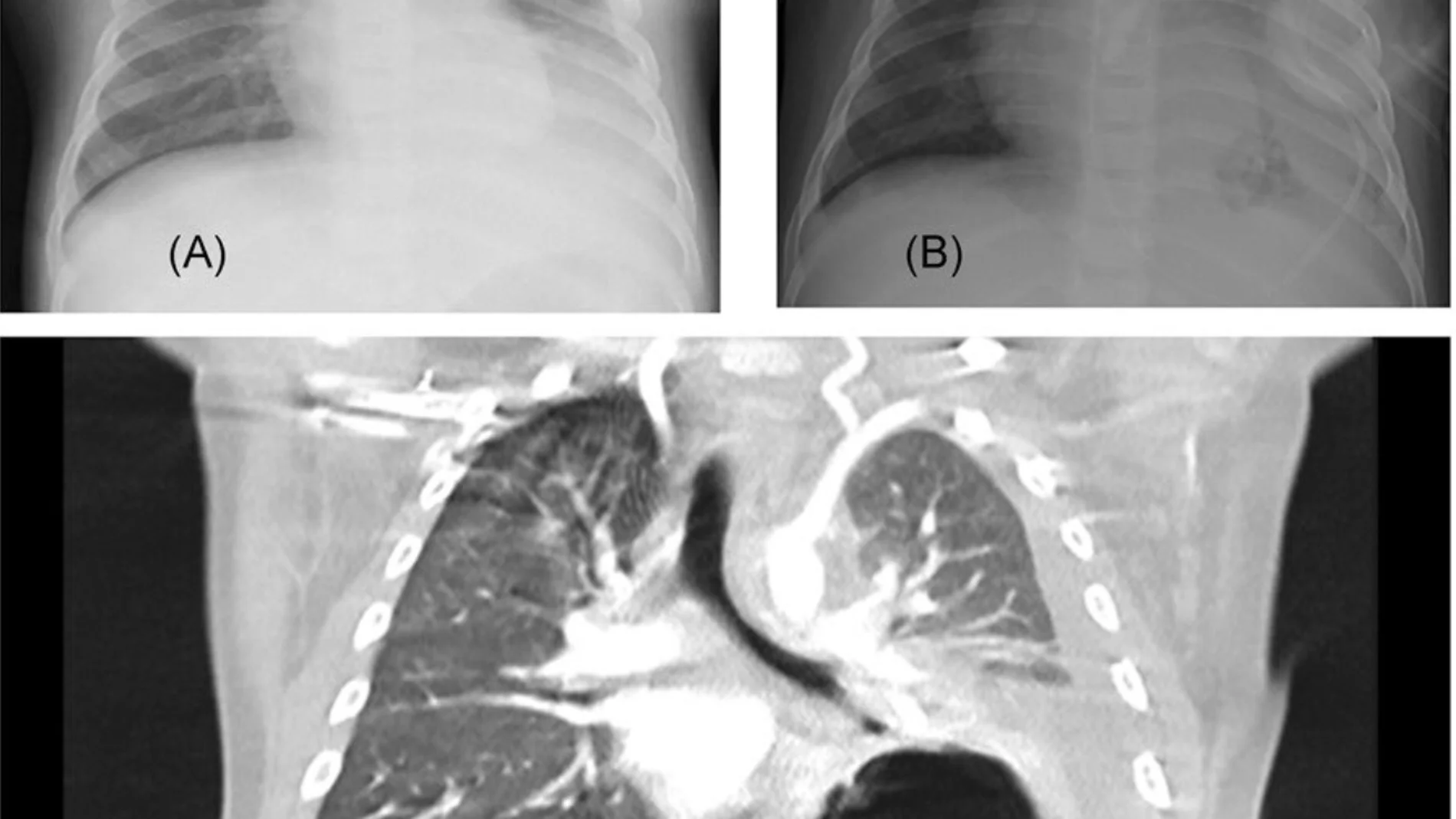 Pulmones con coronavirus Pulmones con coronavirus