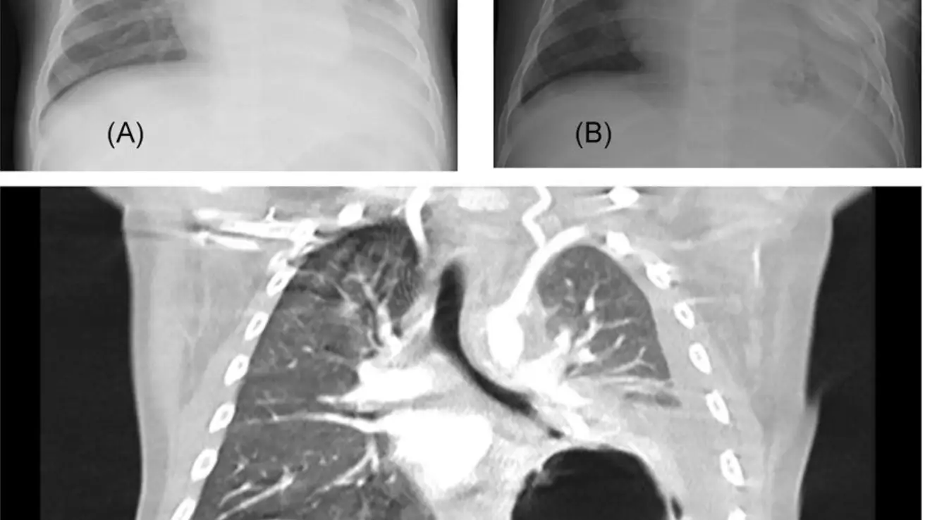 Pulmones con coronavirus