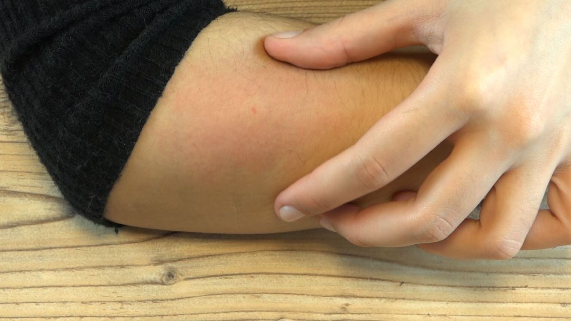 Picadura de mosquito