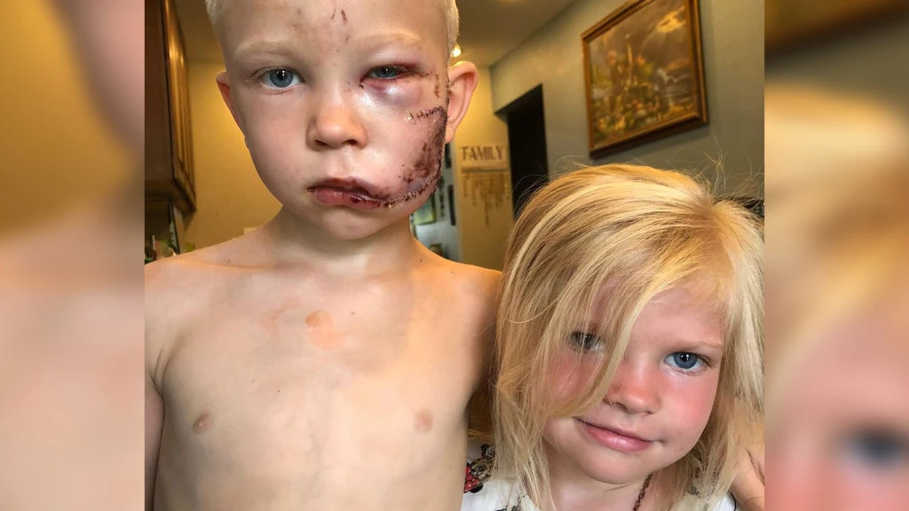 La foto de Bridger Walker tras el ataque del perro La foto de Bridger Walker tras el ataque del perro