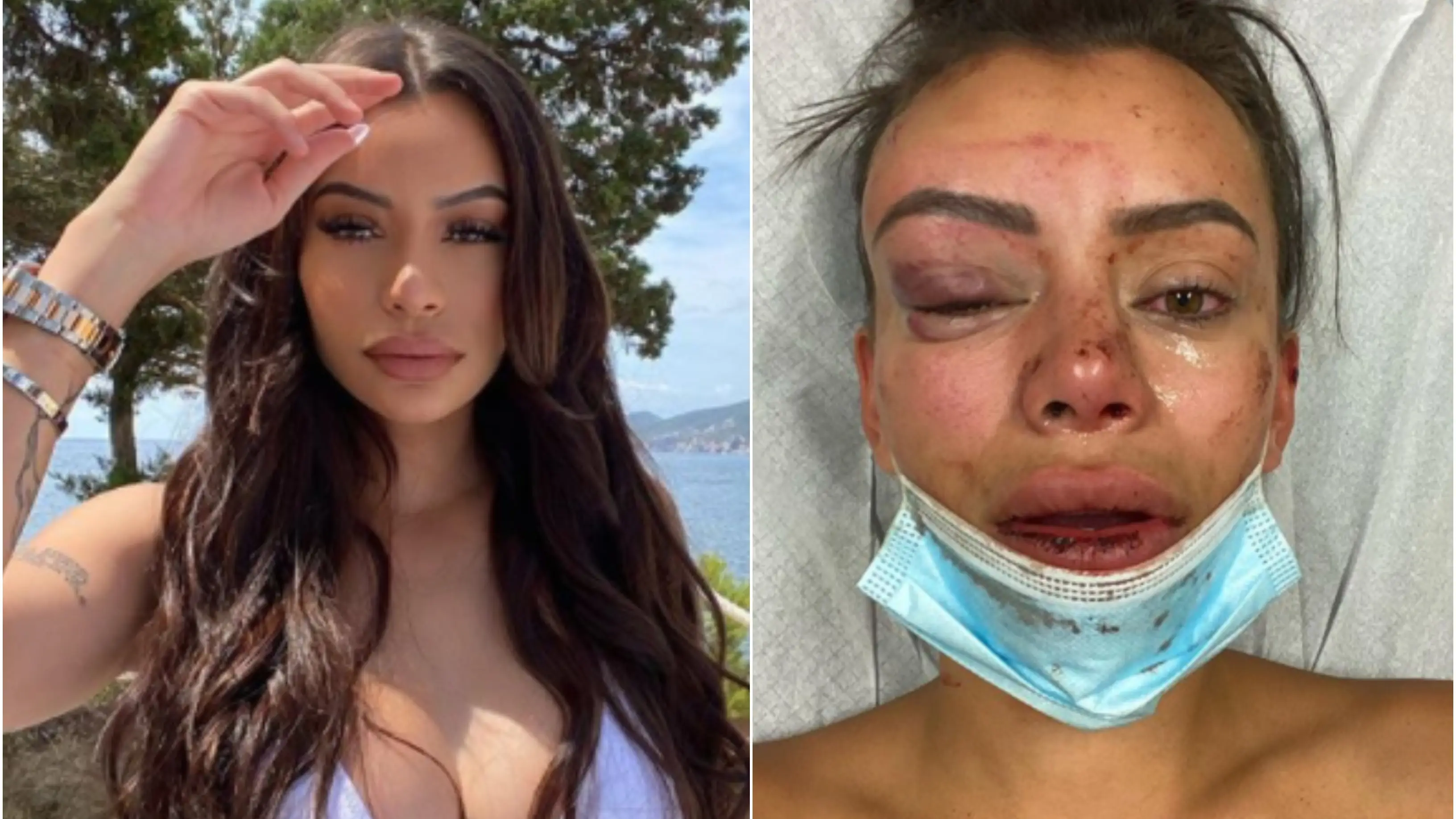Una influencer muestra la terrible paliza que le propin&oacute; un hombre tras una fiesta en su casa