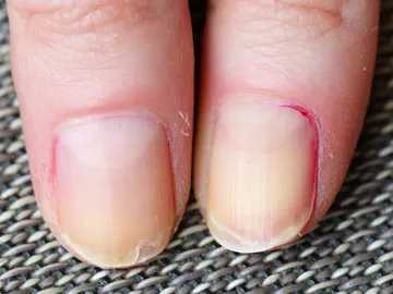 Uñas dañadas y con líneas verticales Uñas dañadas y con líneas verticales