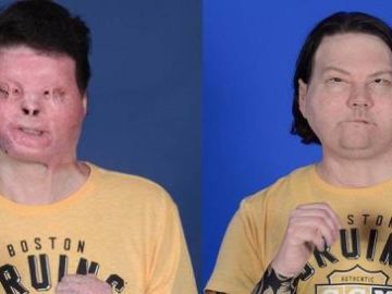 Imagen del antes y después del trasplante simultáneo de rostro y manos