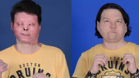 Imagen del antes y después del trasplante simultáneo de rostro y manos Imagen del antes y después del trasplante simultáneo de rostro y manos