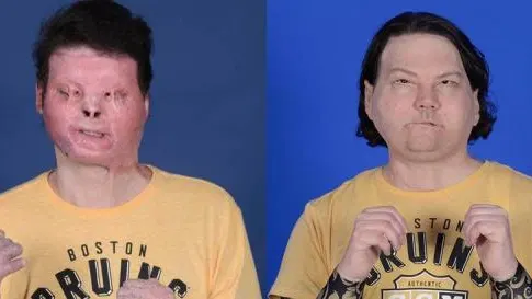 Imagen del antes y después del trasplante simultáneo de rostro y manos Imagen del antes y después del trasplante simultáneo de rostro y manos