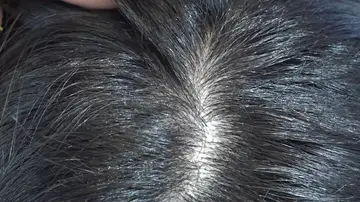 Diferencia entre caspa y cuero cabelludo seco
