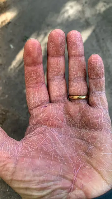 Mano del anestesista Salvatore Quarta. Mano del anestesista Salvatore Quarta.