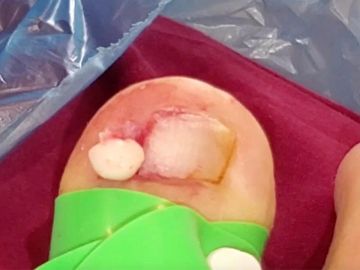 Un pediatra extrae un gigantesco quiste de grasa del dedo gordo de un pie