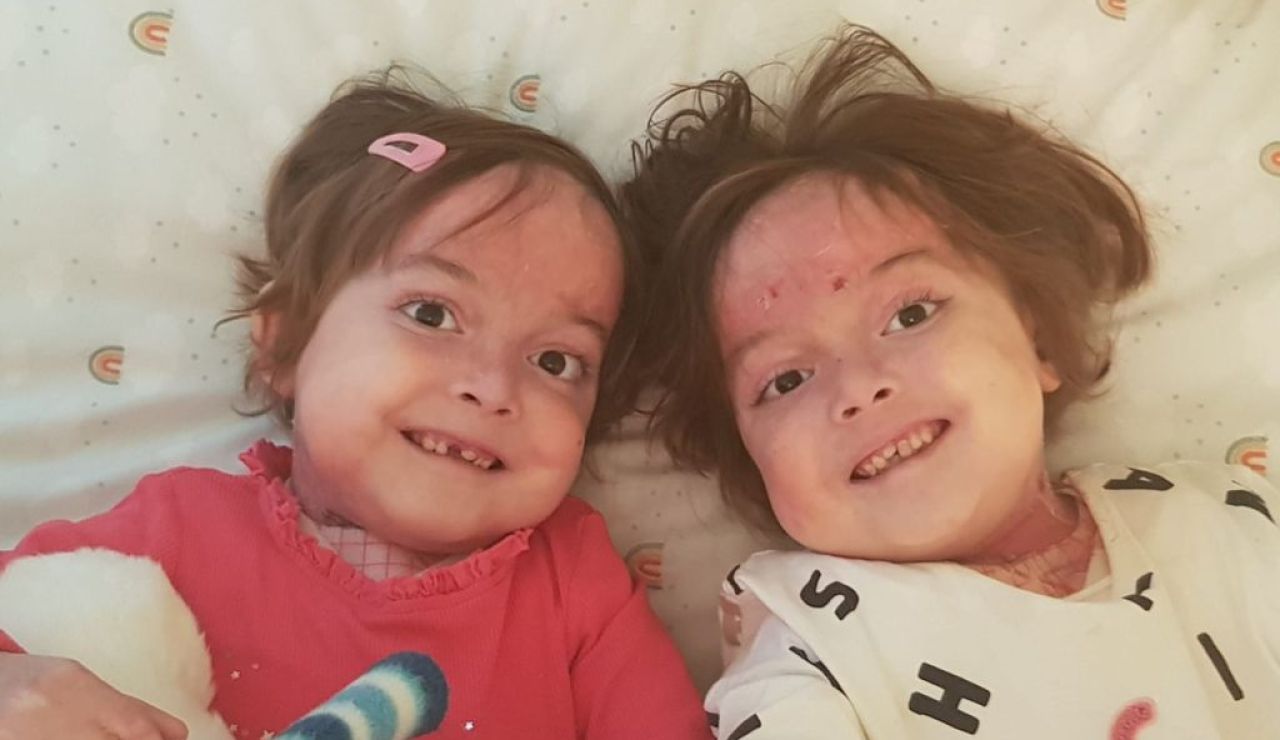 Carla y Noa, las gemelas de seis años con piel de mariposa que solicitan una enfermera que las cure Carla y Noa, las gemelas de seis años con piel de mariposa que solicitan una enfermera que las cure