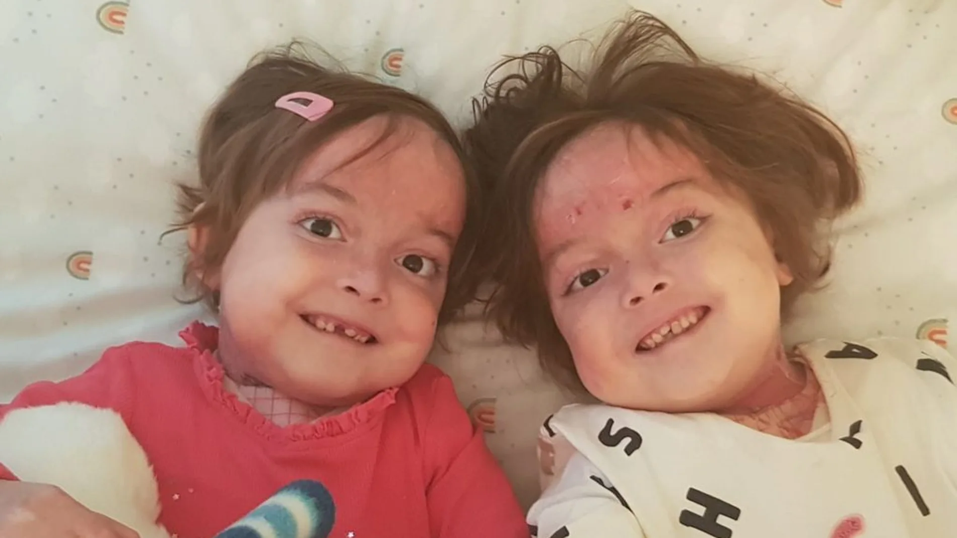 Carla y Noa, las gemelas de seis años con piel de mariposa que solicitan una enfermera que las cure
