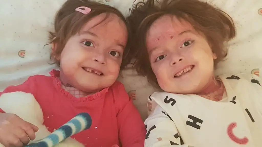 Carla y Noa, las gemelas de seis años con piel de mariposa que solicitan una enfermera que las cure Carla y Noa, las gemelas de seis años con piel de mariposa que solicitan una enfermera que las cure